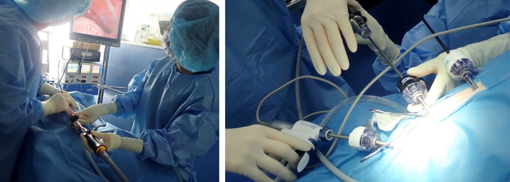 腹腔鏡（カメラ）の挿入の手術風景